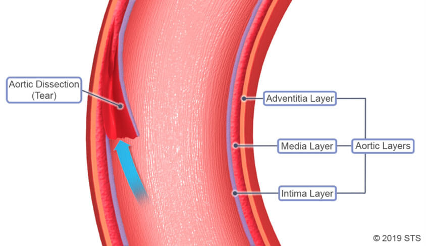 Aortic dissection layers